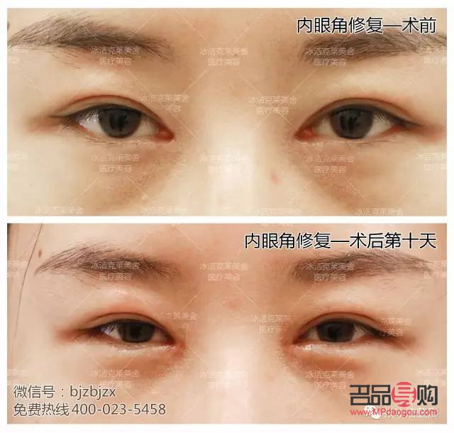 眼角开的有点大了之后还能修复吗(眼角开的有点大了之后还能修复吗图片)