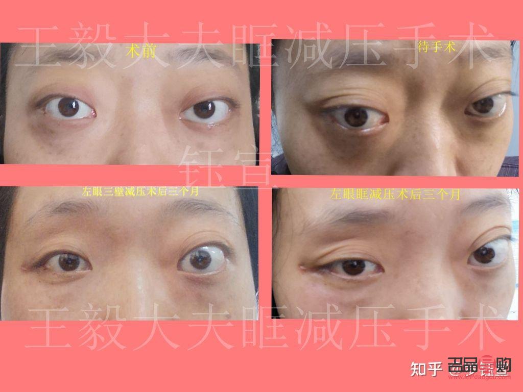 甲亢眼突日常恢复技巧(眼眶减压手术多少钱)