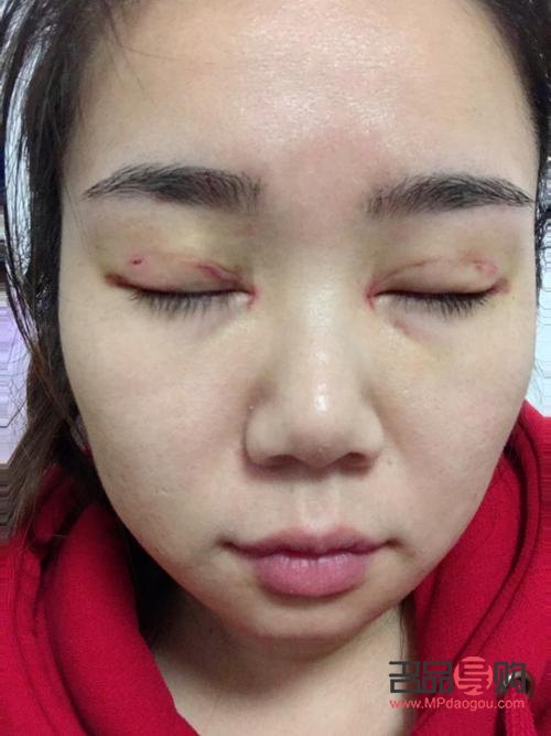 全切双眼皮一般价位是多少(全切双眼皮价格一般在多少)