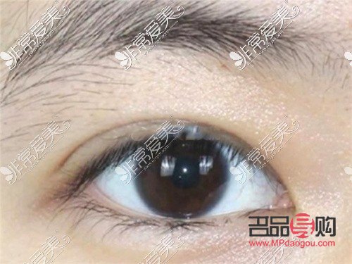 <h3>探索8毫米开扇双眼皮的魅力</h3> <h3>探索8毫米开扇双眼皮的魅力</h3>