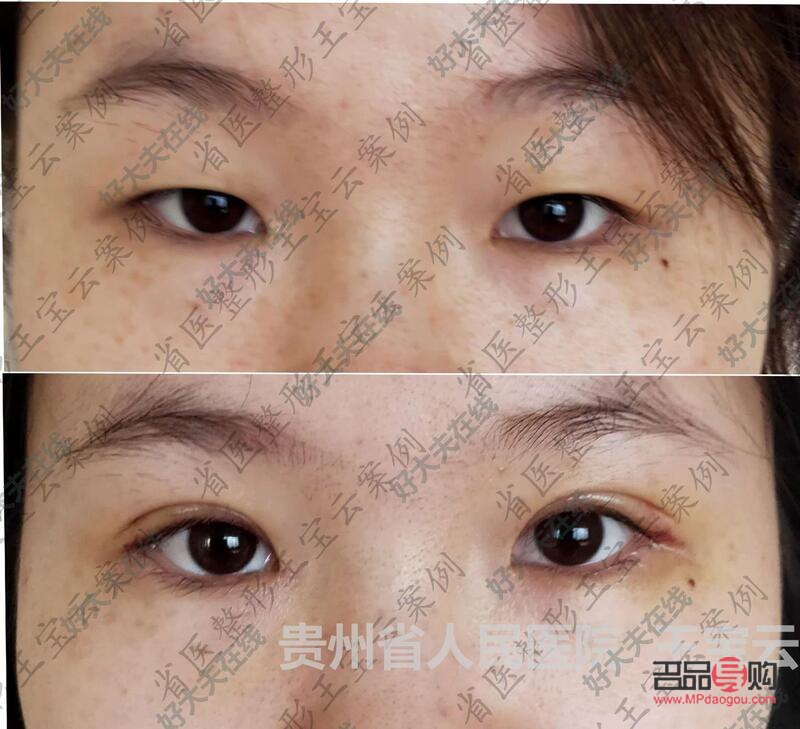 <h3>探索8毫米开扇双眼皮的魅力</h3> <h3>探索8毫米开扇双眼皮的魅力</h3>