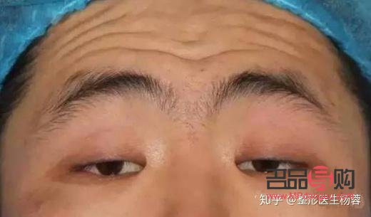 单眼皮肌无力怎样锻炼