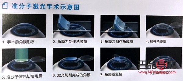 近视眼矫正手术(近视眼矫正手术大概多少钱)