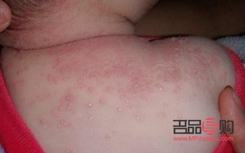 身体出湿疹怎么护理