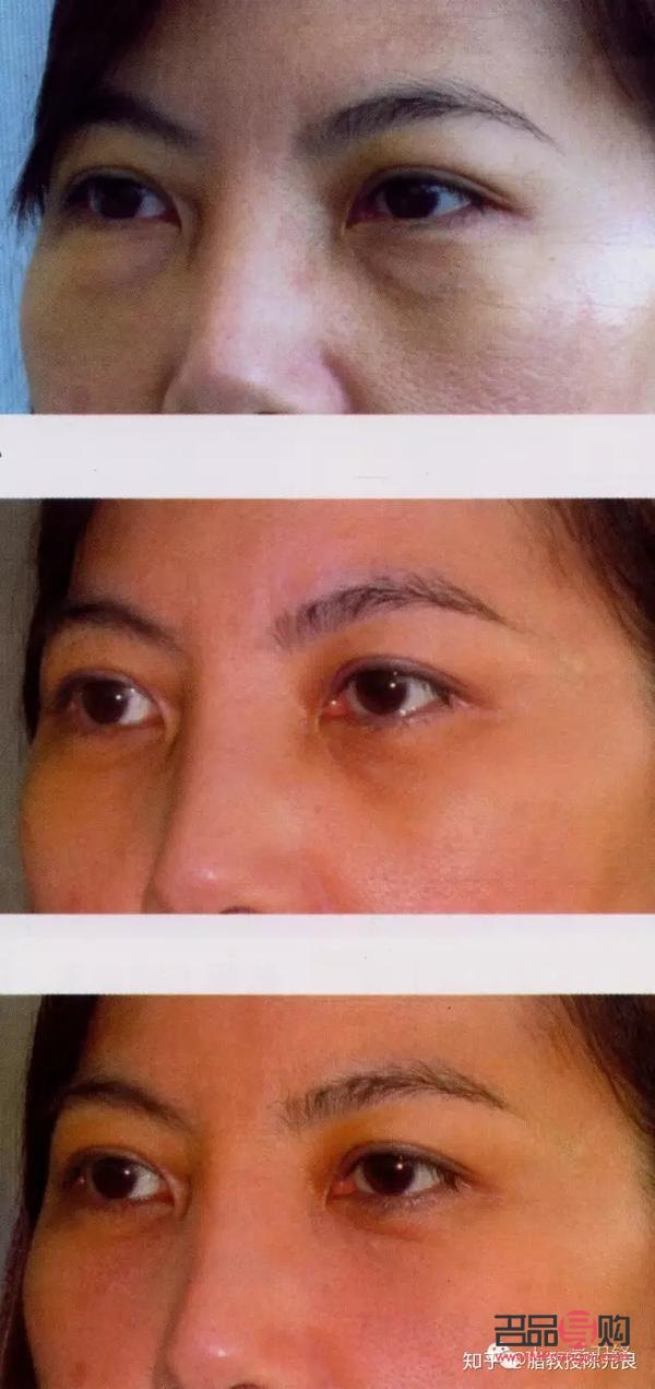 眼周年轻化手术包括哪些项目