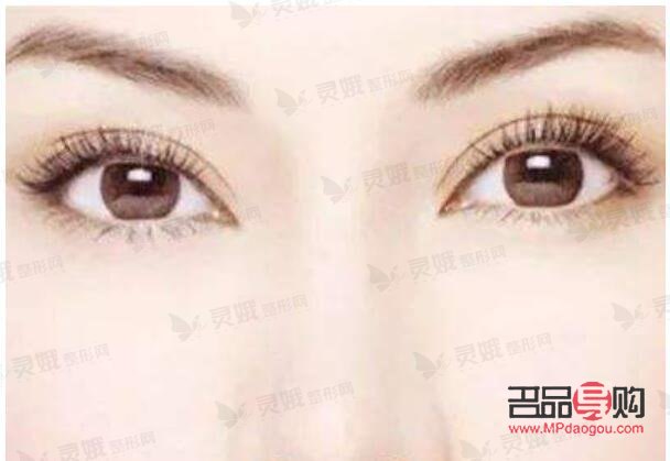 <h3>平扇型双眼皮优点大揭秘</h3> <h3>平扇型双眼皮优点大揭秘</h3>