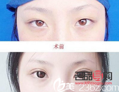 双眼皮都有什么类型图片(双眼皮都有什么类型图片女) 双眼皮都有什么类型图片(双眼皮都有什么类型图片女)