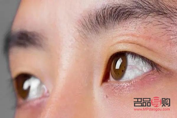 眼睛陷进去了怎么回事(眼睛陷进去了怎么回事儿)