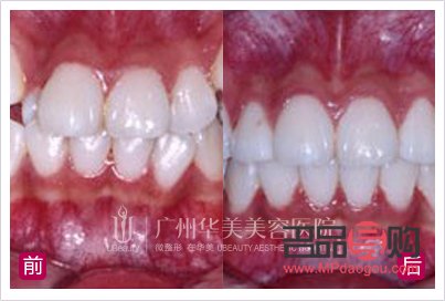 虎牙可以美容冠吗(虎牙可以美容冠吗多少钱) 虎牙可以美容冠吗(虎牙可以美容冠吗多少钱)