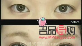 埋线双眼皮会留疤吗？详细解析与注意事项