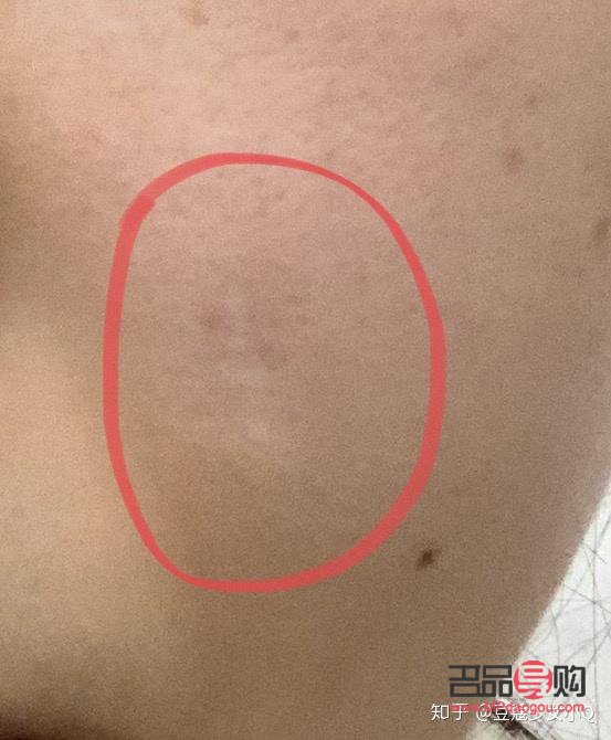 美容针容易留疤吗