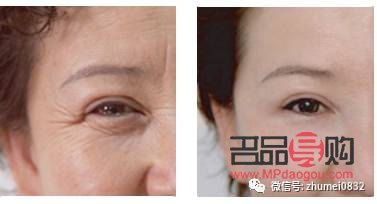 <h3>眼尾下垂图片：解读眼部衰老迹象及改善方法</h3>