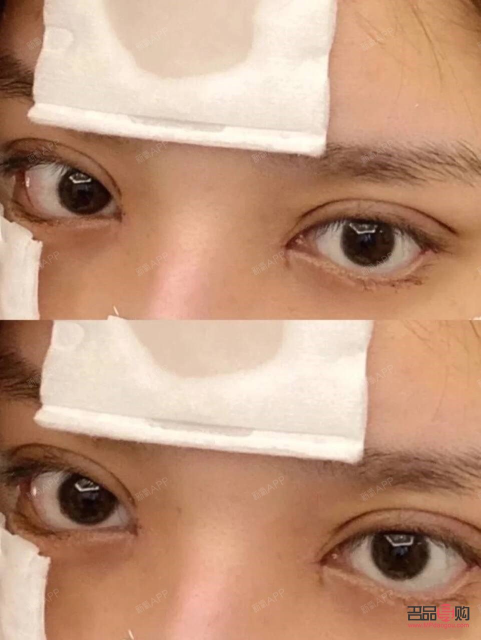 <h3>双眼皮一个月和三个月恢复效果全解析</h3>