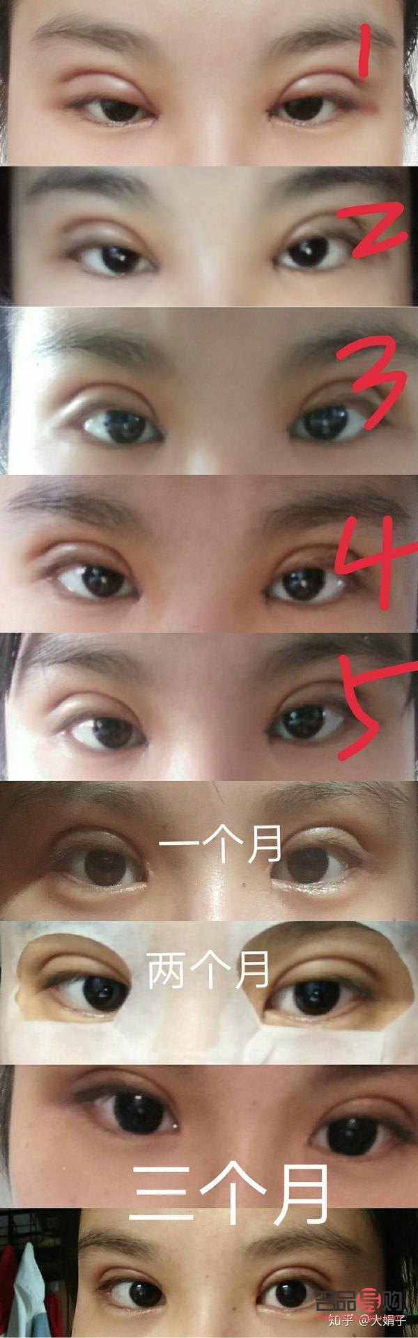 <h3>双眼皮一个月和三个月恢复效果全解析</h3>
