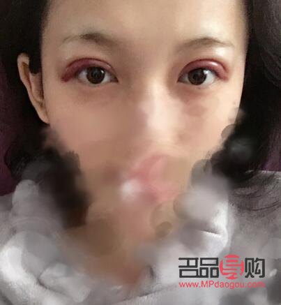 双眼皮一个月和三个月恢复效果全解析