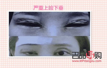 卢玲医生双眼皮案例分享:打造自然双眼皮的匠心之作 卢玲医生双眼皮案例分享:打造自然双眼皮的匠心之作
