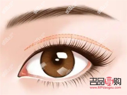 卢玲医生双眼皮案例分享:打造自然双眼皮的匠心之作 卢玲医生双眼皮案例分享:打造自然双眼皮的匠心之作