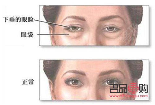 <h3>打了除皱针眼皮下垂能恢复嘛</h3> <h3>打了除皱针眼皮下垂能恢复嘛</h3>