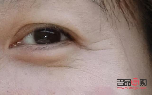 打了除皱针眼皮下垂能恢复嘛