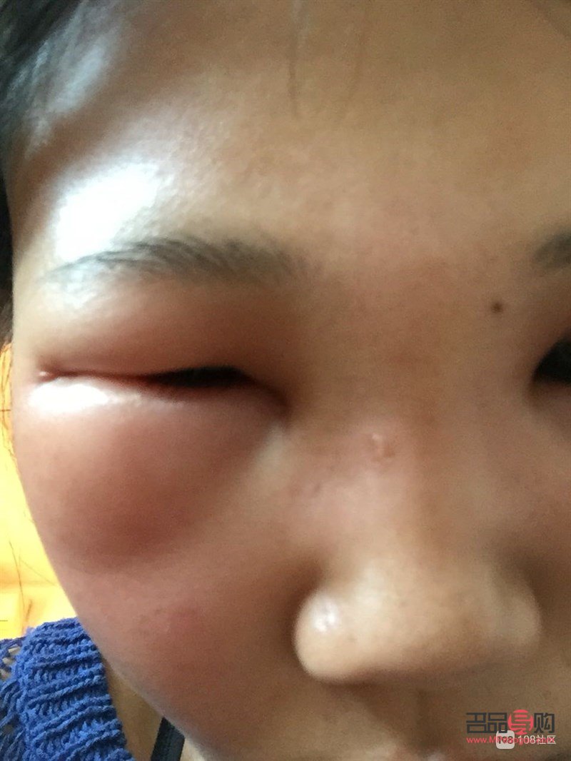 上眼皮肿眼泡怎么消除用啥中成药(上眼皮肿眼泡怎么消除用啥中成药好) 上眼皮肿眼泡怎么消除用啥中成药(上眼皮肿眼泡怎么消除用啥中成药好)