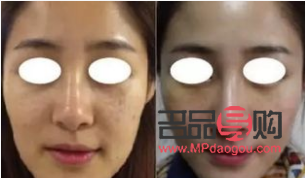 美容埋线怎么回事(美容埋线是怎么回事)