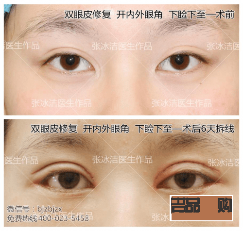 双眼皮变成三眼皮是怎么回事(双眼皮变成三眼皮是怎么回事玄学)