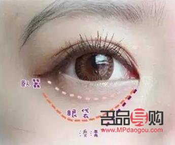 眼轮匝肌肥厚型眼袋怎么去除(眼轮匝肌肥厚型眼袋怎么去除最有效)