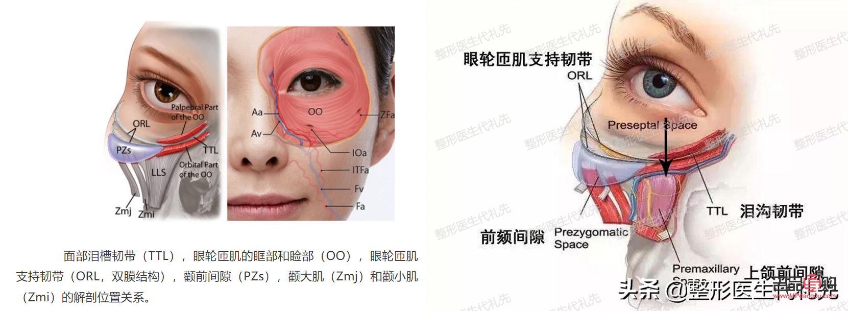 眼轮匝肌肥厚型眼袋怎么去除(眼轮匝肌肥厚型眼袋怎么去除最有效)