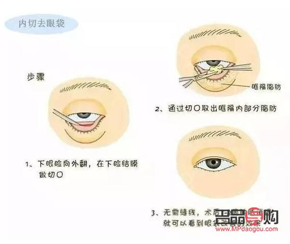 <h3>眼角下垂 怎么提升</h3> <h3>眼角下垂 怎么提升</h3>