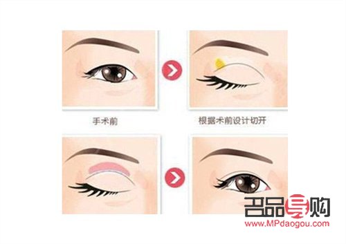 眼角下垂 怎么提升