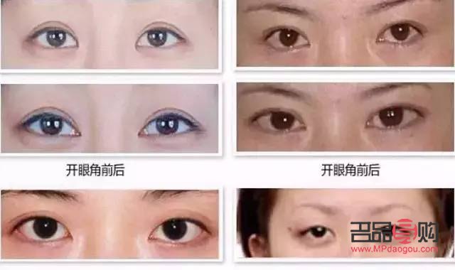 开眼角哪家美名(哪家做开眼角好啊)