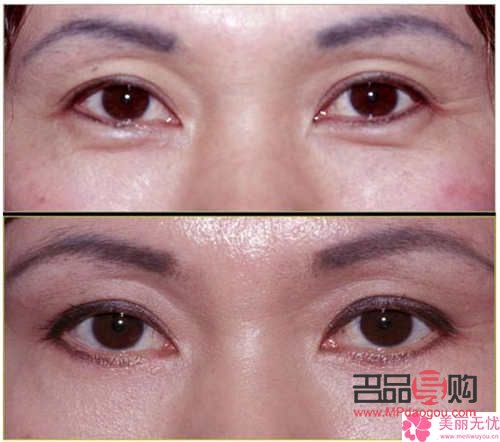 内切眼袋可以维持几年(内切眼袋可以维持几年寿命) 内切眼袋可以维持几年(内切眼袋可以维持几年寿命)