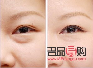 内切眼袋可以维持几年(内切眼袋可以维持几年寿命)