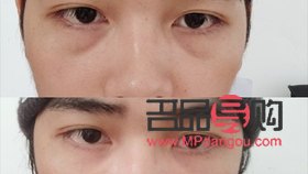 眼窝凹陷自体脂肪填充有风险吗(眼窝凹陷自体脂肪填充有风险吗视频)