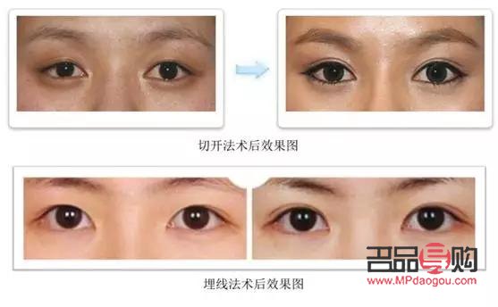 <h3>6D翘睫双眼皮与埋线技术解析</h3> <h3>6D翘睫双眼皮与埋线技术解析</h3>