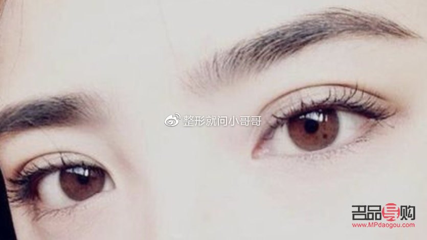 <h3>肉条双眼皮是什么样子?详解双眼皮类型与特征</h3> <h3>肉条双眼皮是什么样子?详解双眼皮类型与特征</h3>