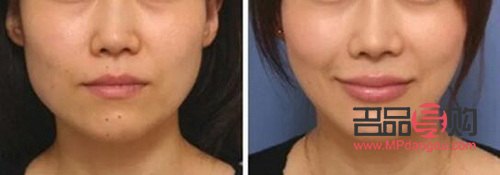 <h3>高低眉大小眼歪脸矫正方法大揭秘</h3> <h3>高低眉大小眼歪脸矫正方法大揭秘</h3>