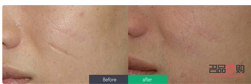 美容院怎么去疤痕(美容院可以去疤痕吗)