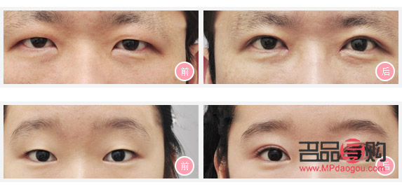 <h3>眼皮松弛适合做哪种双眼皮</h3> <h3>眼皮松弛适合做哪种双眼皮</h3>