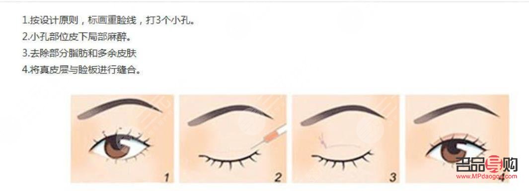 定点双眼皮视频全过程(定点双眼皮视频全过程教程)