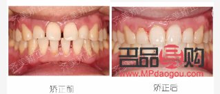 门牙美容冠是什么(门牙美容冠是什么材质)