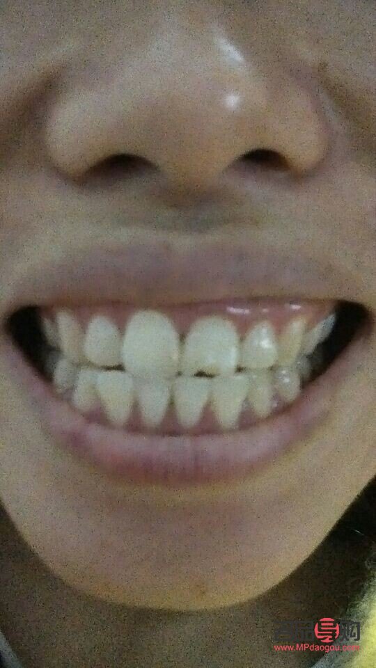 门牙美容冠是什么(门牙美容冠是什么材质)