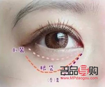 黑眼圈泪沟眼袋的区别图片(黑眼圈眼袋泪沟图片区分)