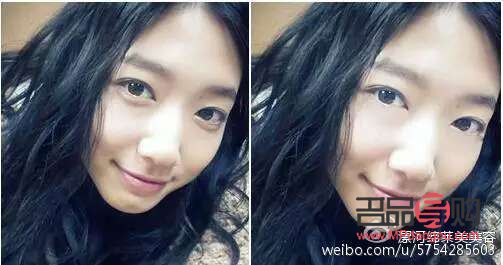 黑眼圈泪沟眼袋的区别图片(黑眼圈眼袋泪沟图片区分)