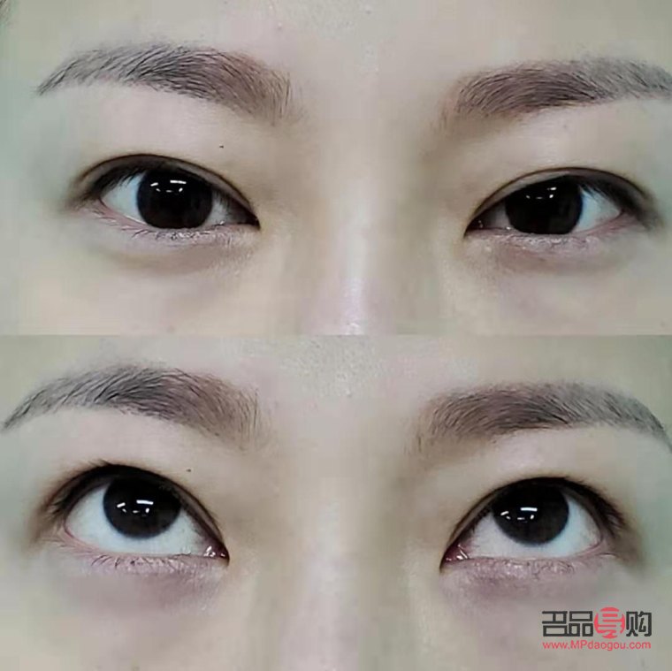 割双眼皮对眼睛有什么影响(割双眼皮对眼睛有什么影响吗)