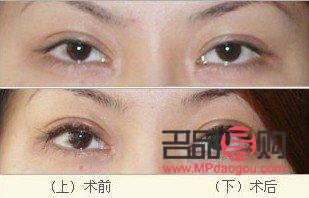 割双眼皮对眼睛有什么影响(割双眼皮对眼睛有什么影响吗)