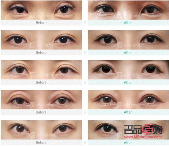 <h3>改变眼型：探索眼部整形的奥秘与美学</h3>