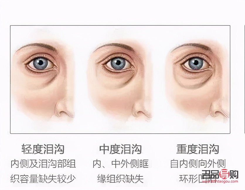 <h3>眼袋加泪沟综合手术多少钱？全面解析手术费用及影响因素</h3>