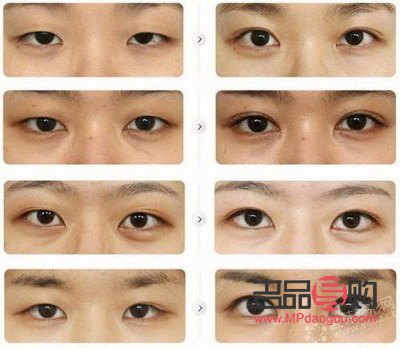 双眼皮改单眼皮成功了(双眼皮改单眼皮成功了会怎么样)