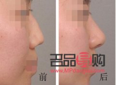 手术美容线多少钱(手术美容线多少钱一根)